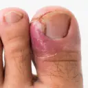 UÑERO INYECTABLE MEDICO