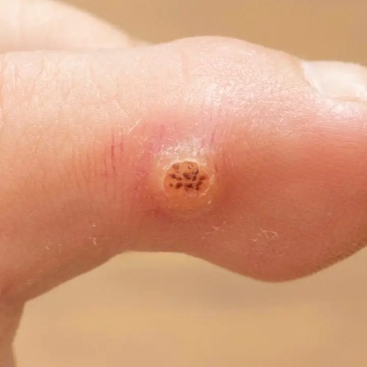 VERRUGA PLANTAR ADICIONALES