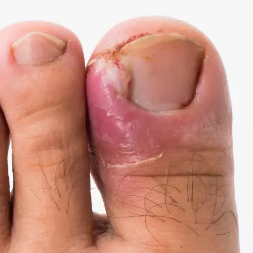 [CMS42] UÑERO INYECTABLE MEDICO