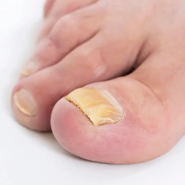 MEDI PEDI ONICOMICOSIS 2 UÑAS